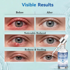 Nexkayee applying serum gently to eyelid highlighting targeted soothing benefit