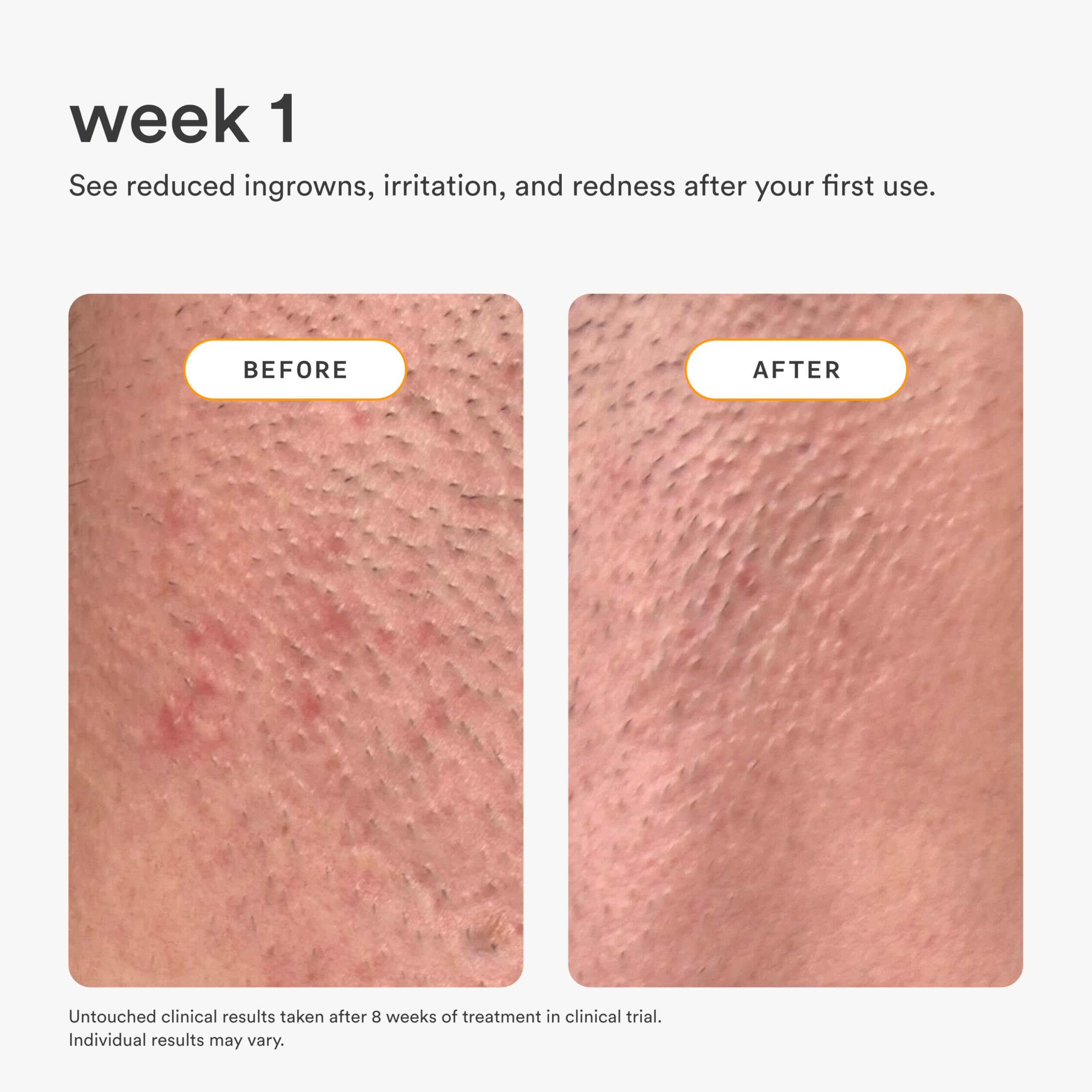 Nood serum on bikini line area preventing ingrown hairs and calming redness
