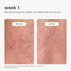 Nood serum on bikini line area preventing ingrown hairs and calming redness