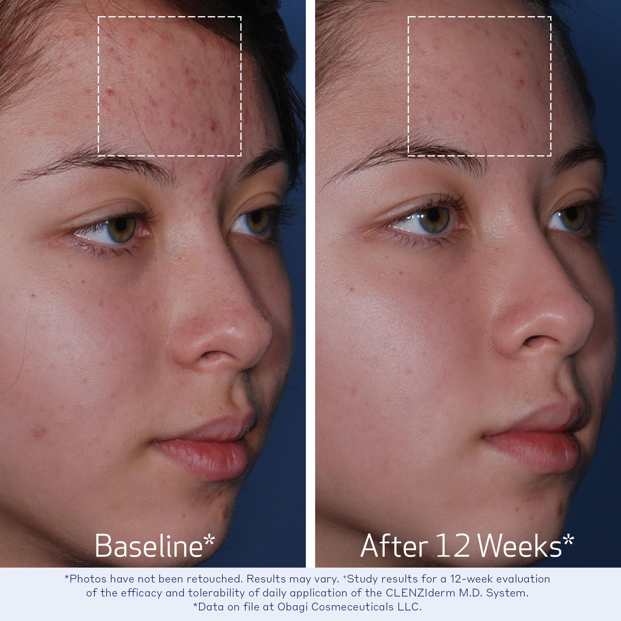 Obagi Medical toner on cotton pad illustrating pore-exfoliating application