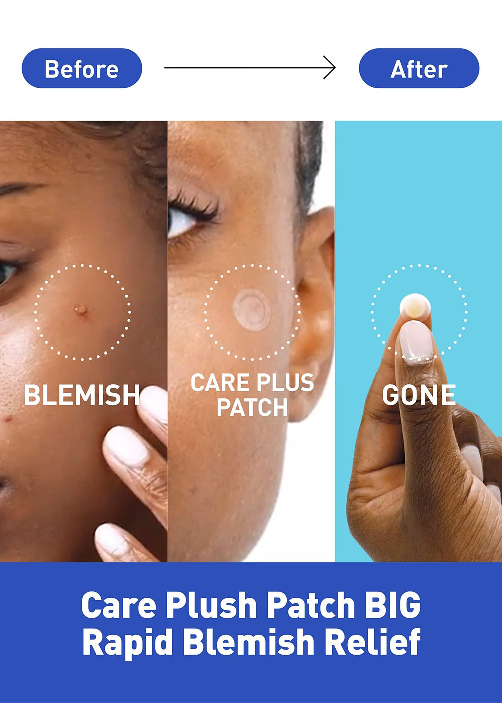 OLIVE YOUNG close-up of single hydrocolloid patch texture for discreet coverage