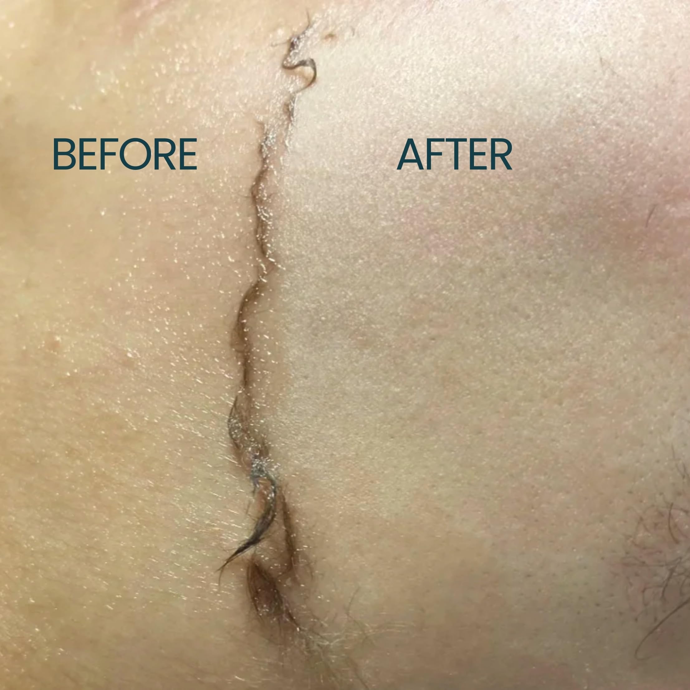 Ouiloe used during dermaplaning showing smoother glide benefit