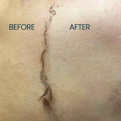 Ouiloe used during dermaplaning showing smoother glide benefit