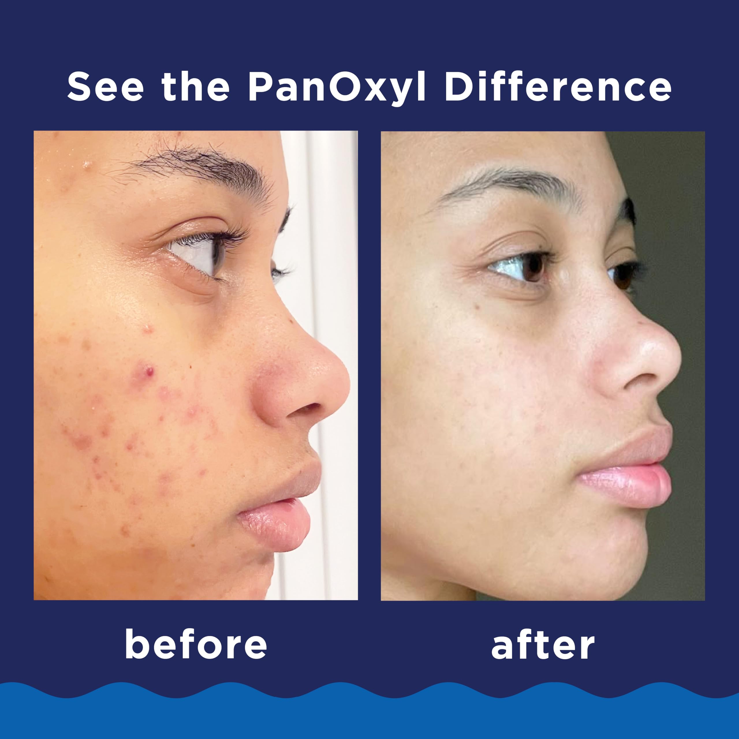 PanOxyl travel size in hand highlighting portability and convenience