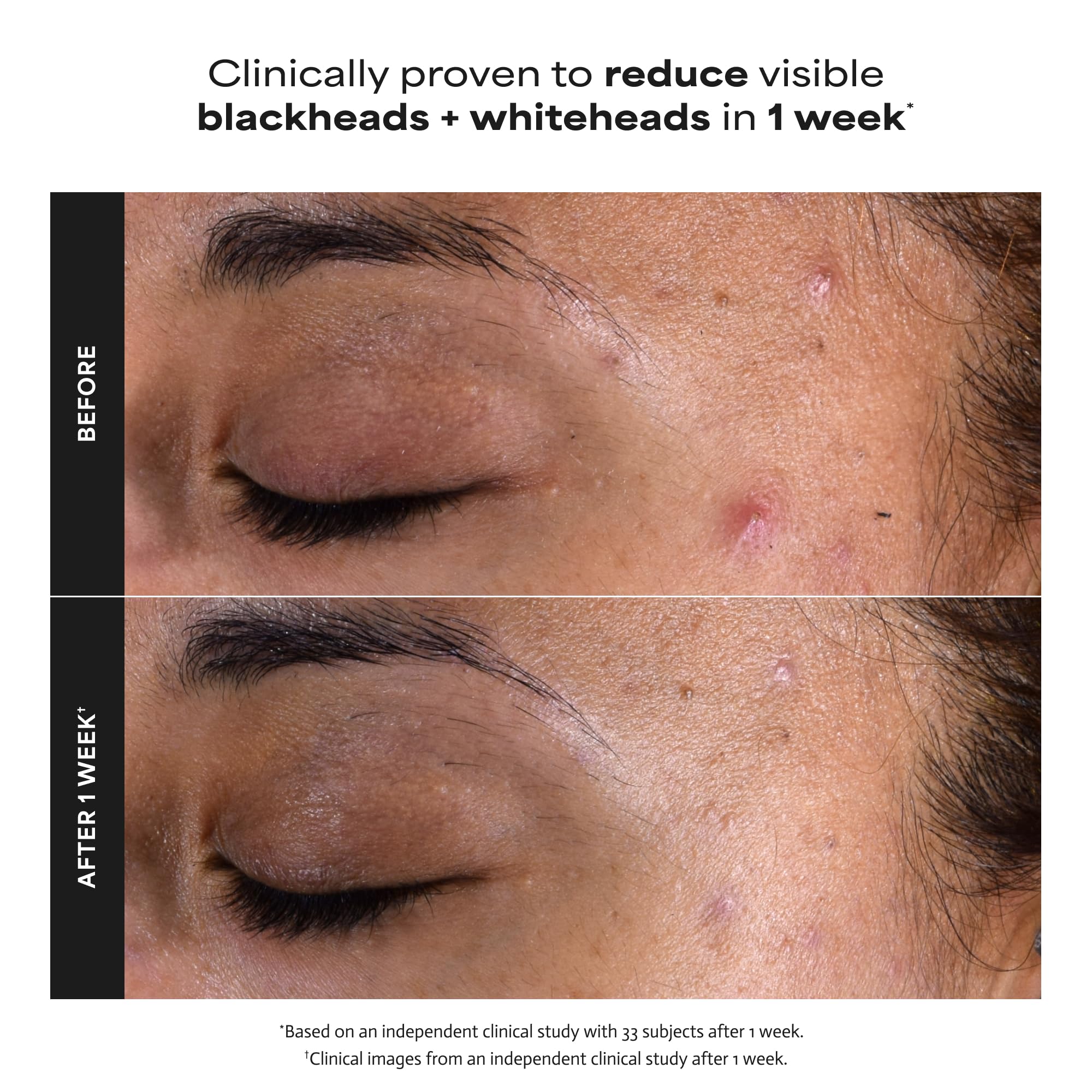 Applying Paula's Choice exfoliant with a cotton pad to show gentle, leave-on use and pore-clearing benefit