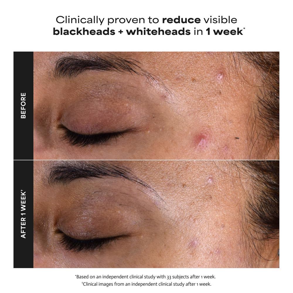 Paula's Choice applied to cotton pad showing easy application and gentle exfoliation