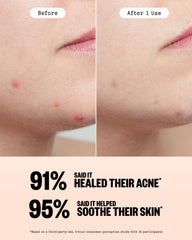 PEACE OUT ingredient visual with salicylic acid and retinol icons