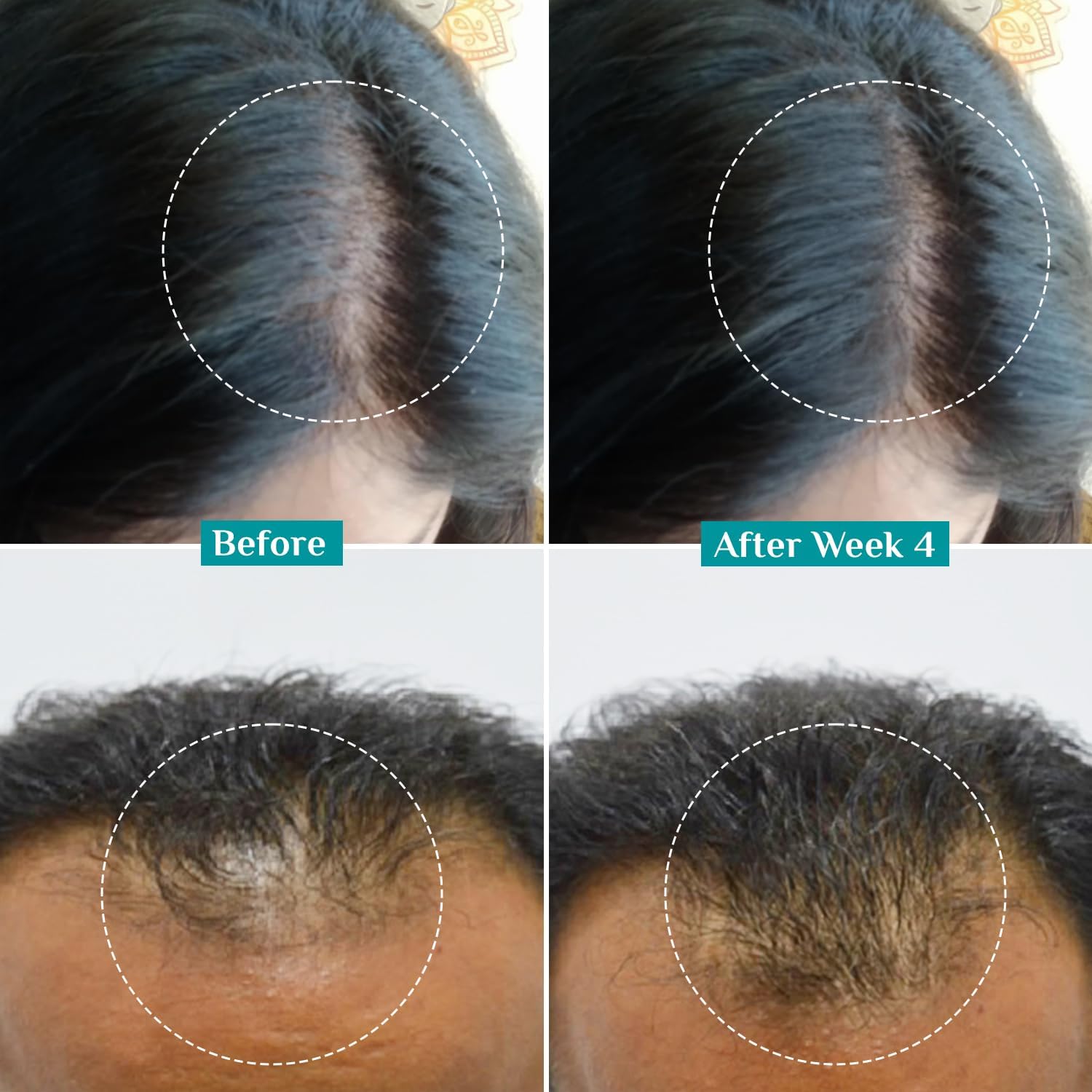 Pilgrim application on scalp with dropper, illustrates targeted follicle nourishment