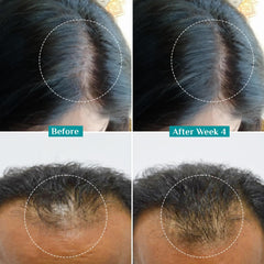 Pilgrim application on scalp with dropper, illustrates targeted follicle nourishment