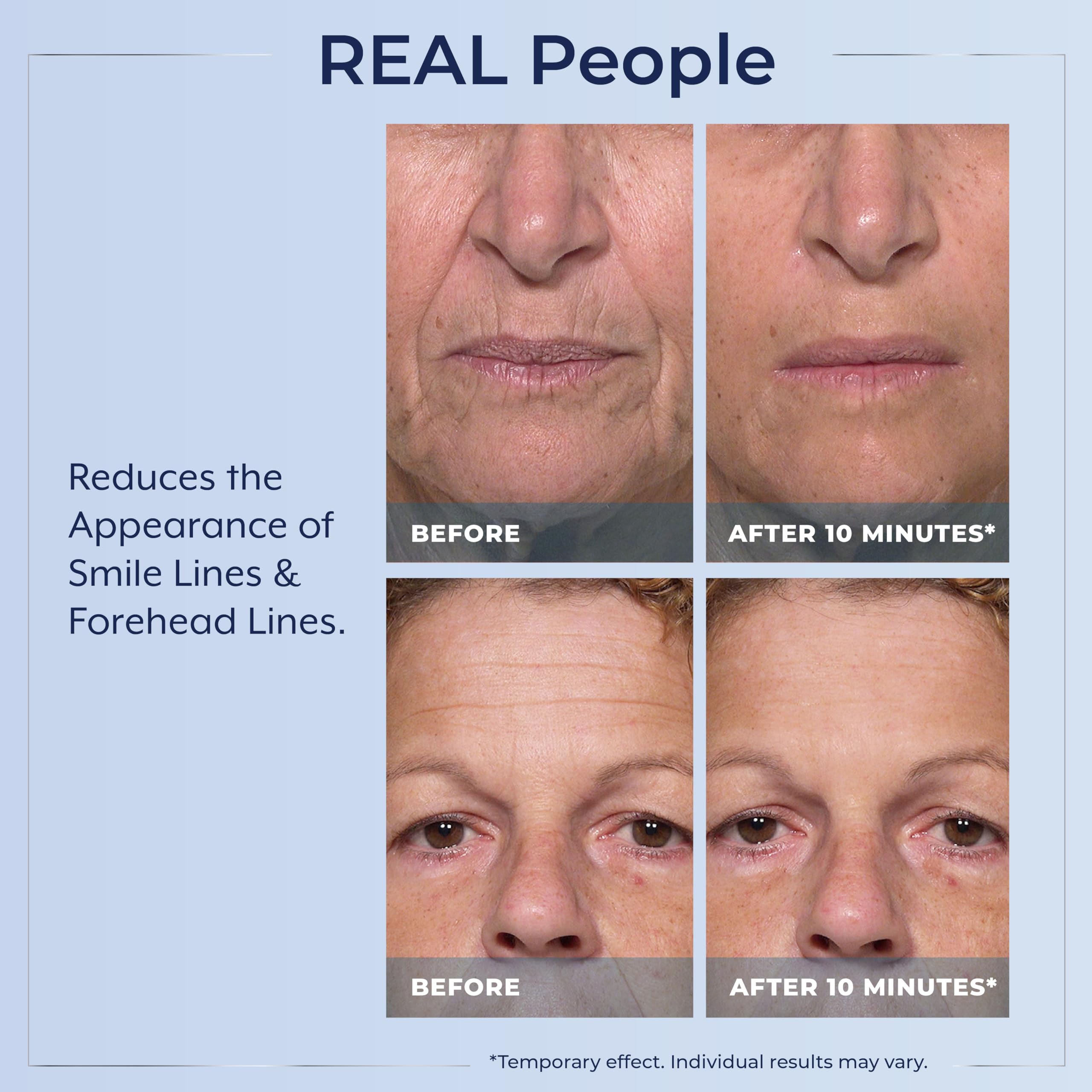 Plexaderm being applied under eye to reduce bags and lines visibly