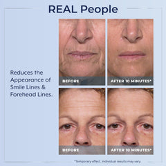 Plexaderm being applied under eye to reduce bags and lines visibly