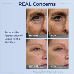 Plexaderm before and after closeup showing visible smoothing