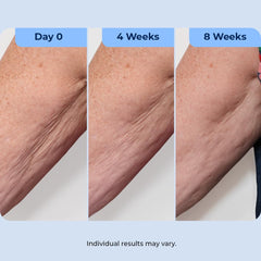 Plexaderm being applied to neck demonstrating targeted use and improved texture