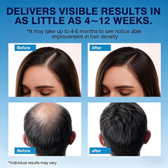 Quilom foam applied to thinning scalp showing targeted coverage and non-greasy finish