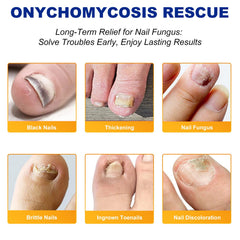 ReliCo patch applied on toenail for targeted overnight treatment