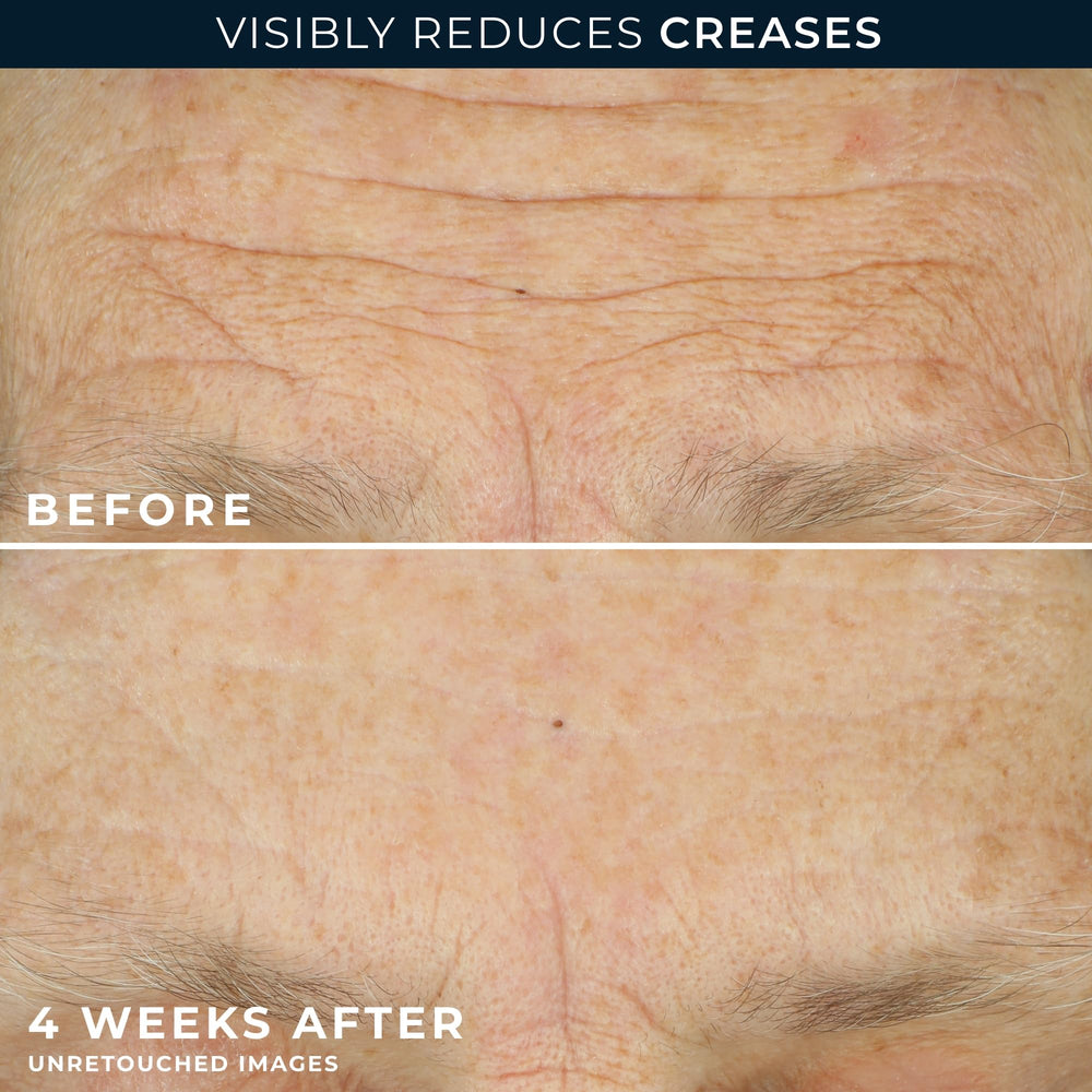 RoC capsule held in hand showing measured retinol dose for skin renewal
