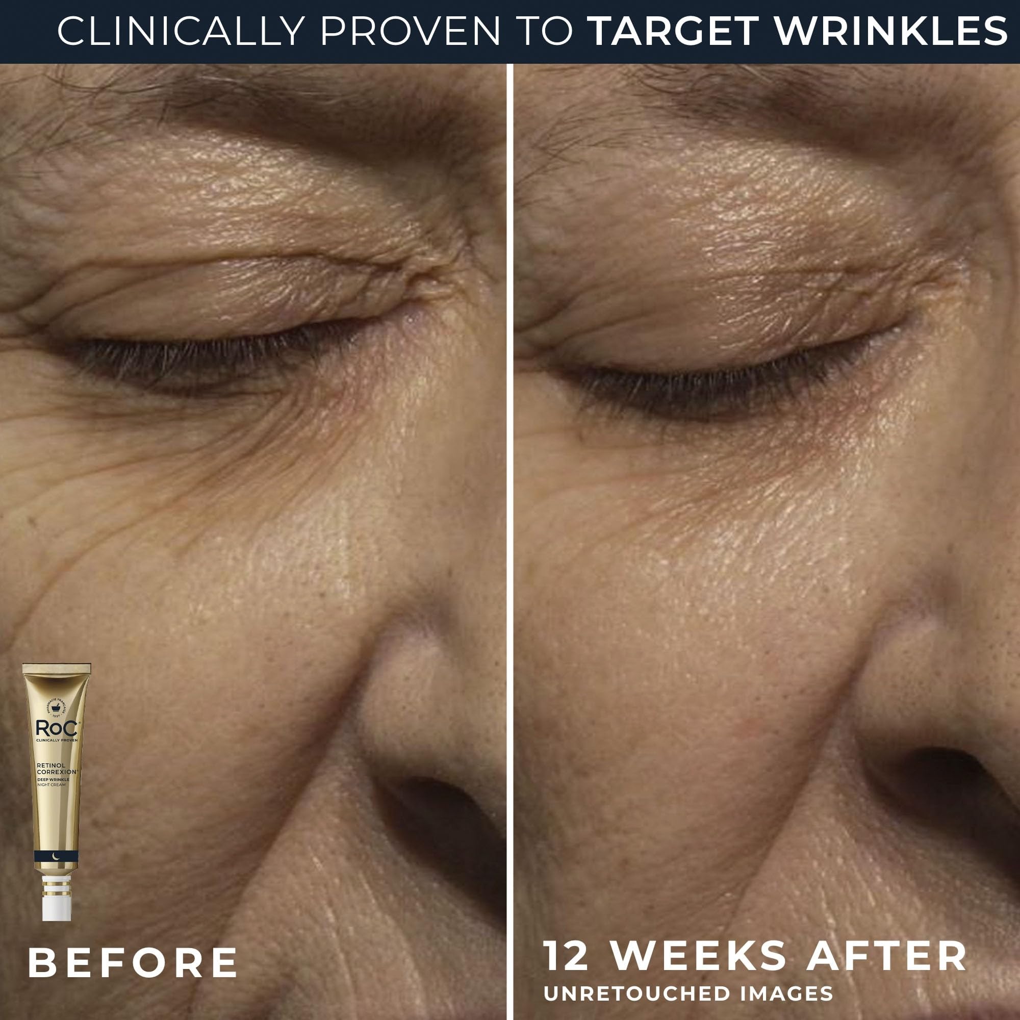 RoC eye cream applied beneath eye demonstrating reduced puffiness benefit