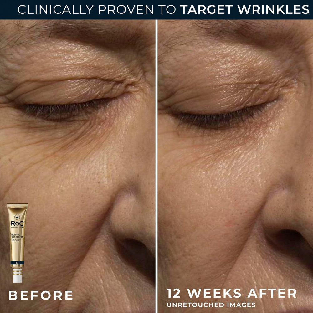 RoC eye cream applied beneath eye demonstrating reduced puffiness benefit