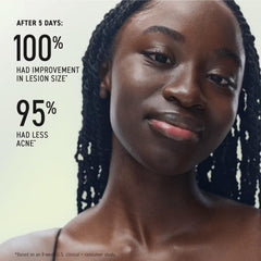 Rodan + Fields treatment tube label visible to confirm active acne ingredients
