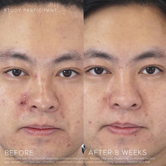 Rodan + Fields applied to cheek area illustrating targeted blemish coverage and controlled dosing