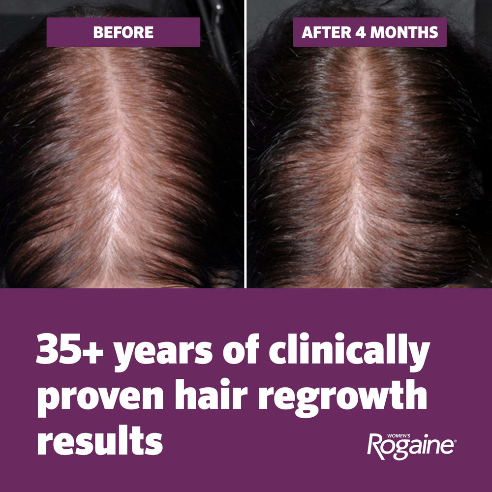 Rogaine being applied to scalp demonstrating targeted treatment