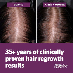 Rogaine being applied to scalp demonstrating targeted treatment