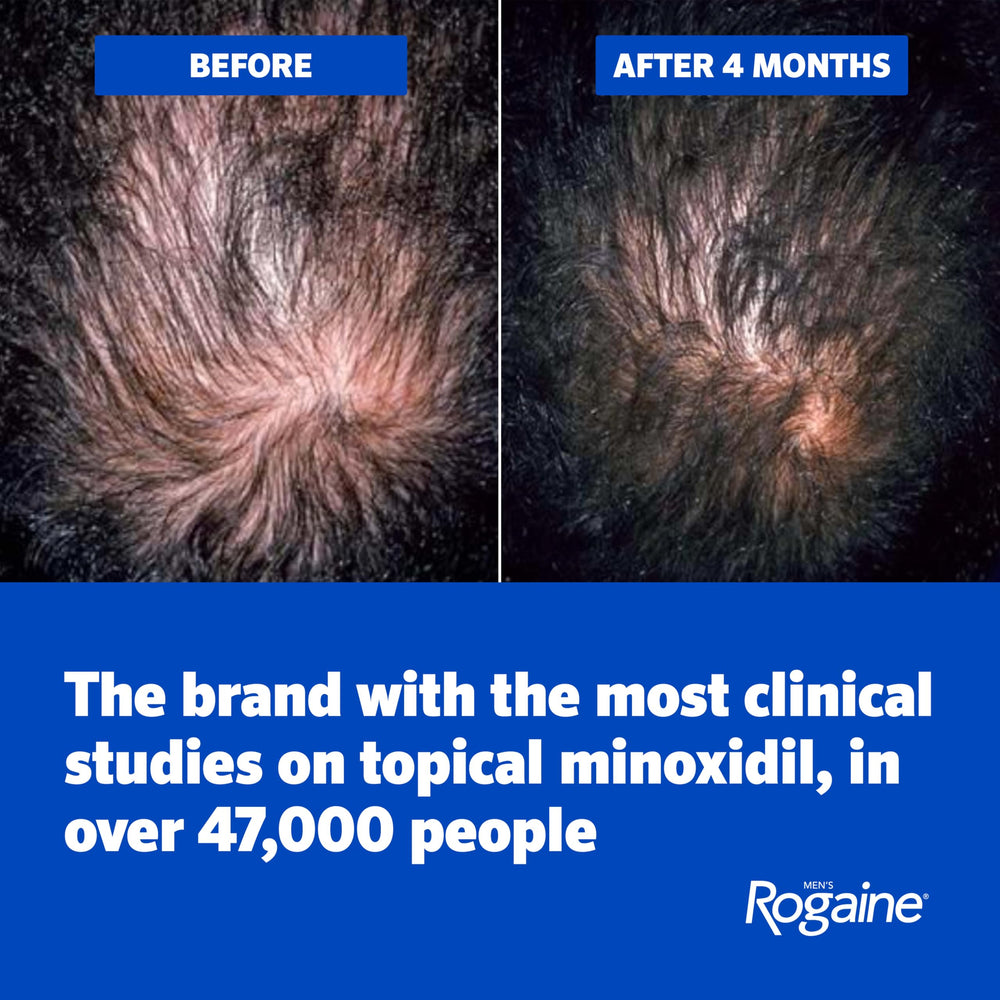 Applying Rogaine foam to scalp demonstrating easy targeted use