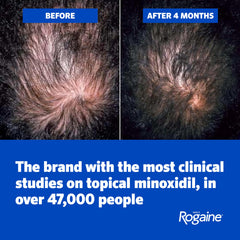 Applying Rogaine foam to scalp demonstrating easy targeted use