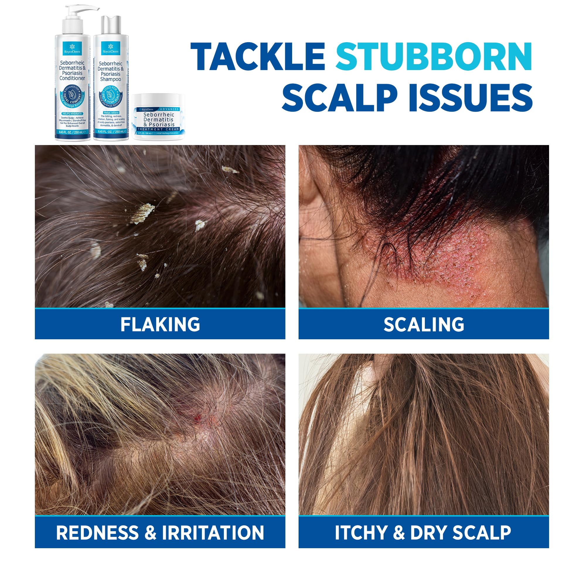 Roycederm cream applied to scalp showing spot treatment for irritated patches