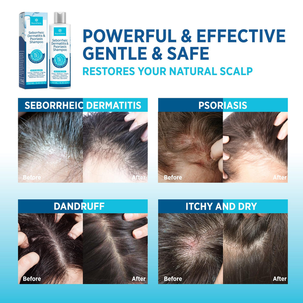 Roycederm shampoo creating lather to lift flakes and clarify scalp