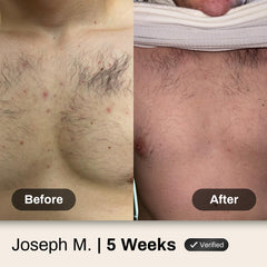 Shield in-shower use on back demonstrating effective acne cleansing