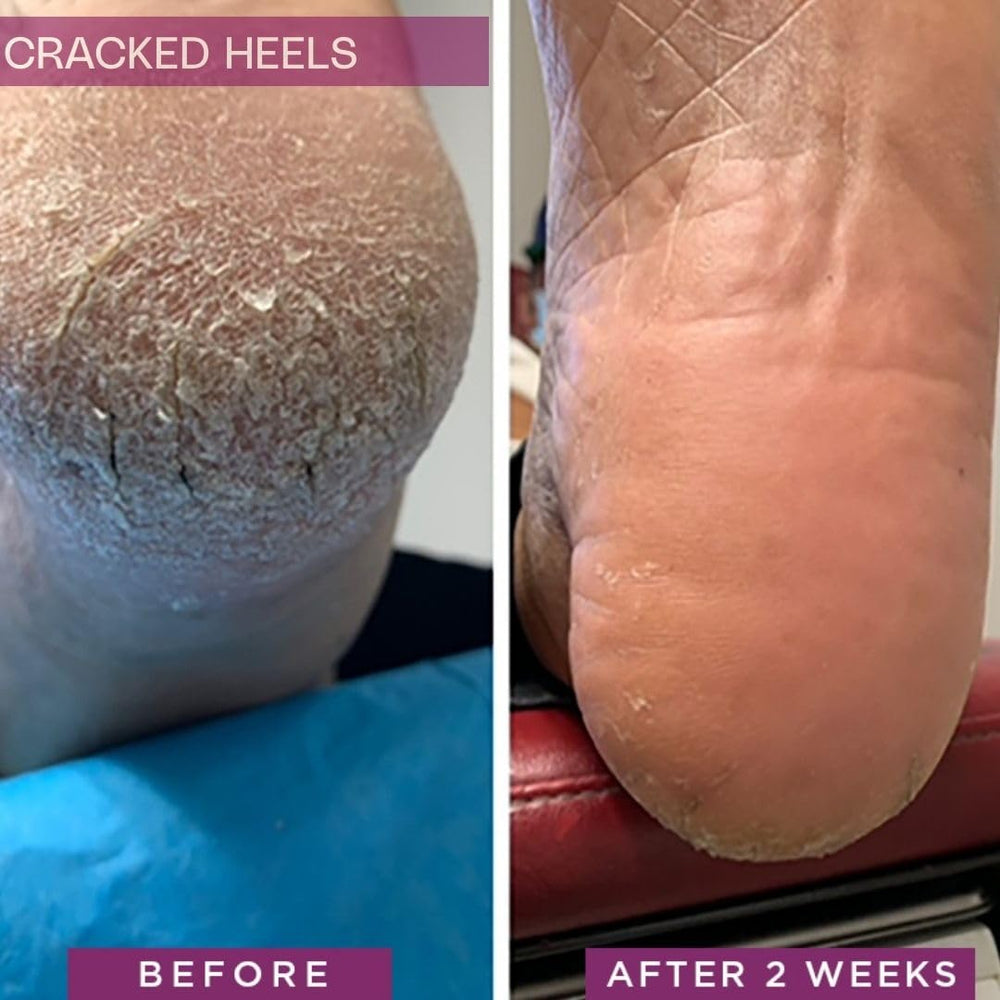 SkinIntegra being applied to a cracked heel in hand, demonstrating targeted relief