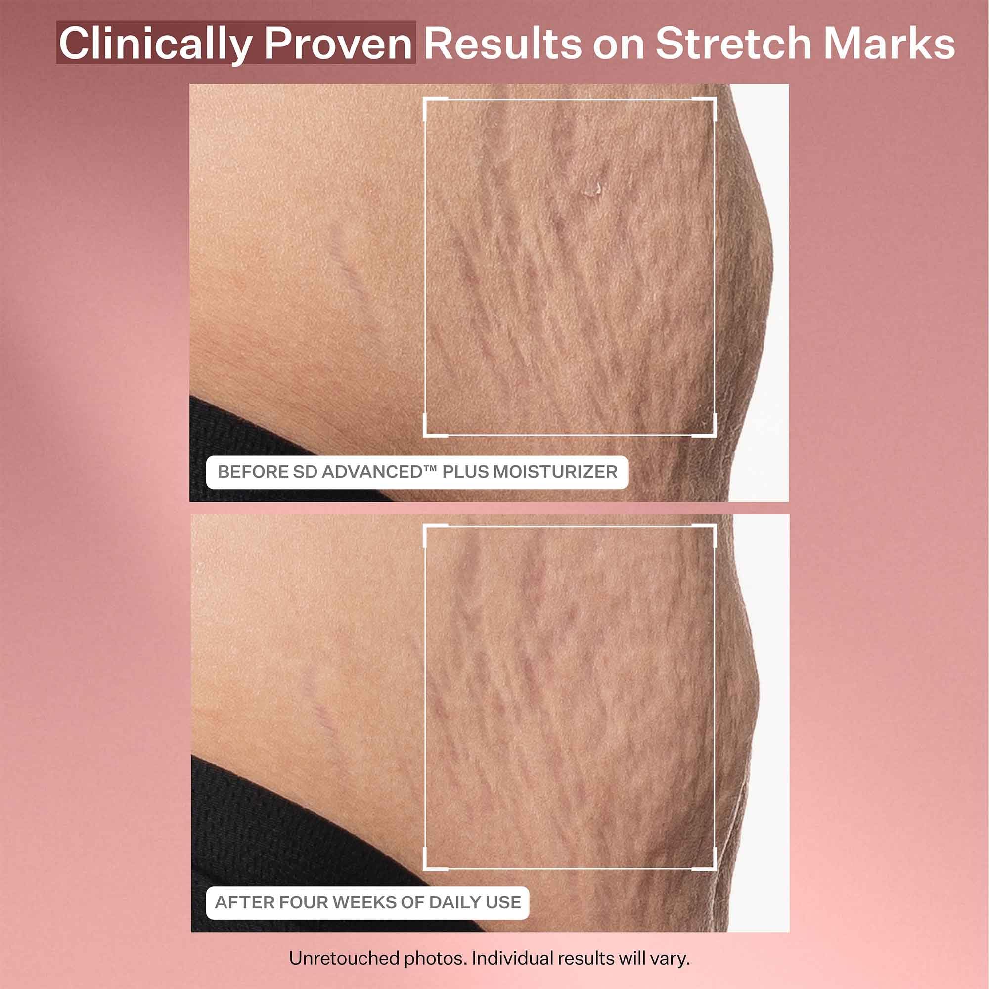 StriVectin being applied to thighs to help improve stretchmark appearance