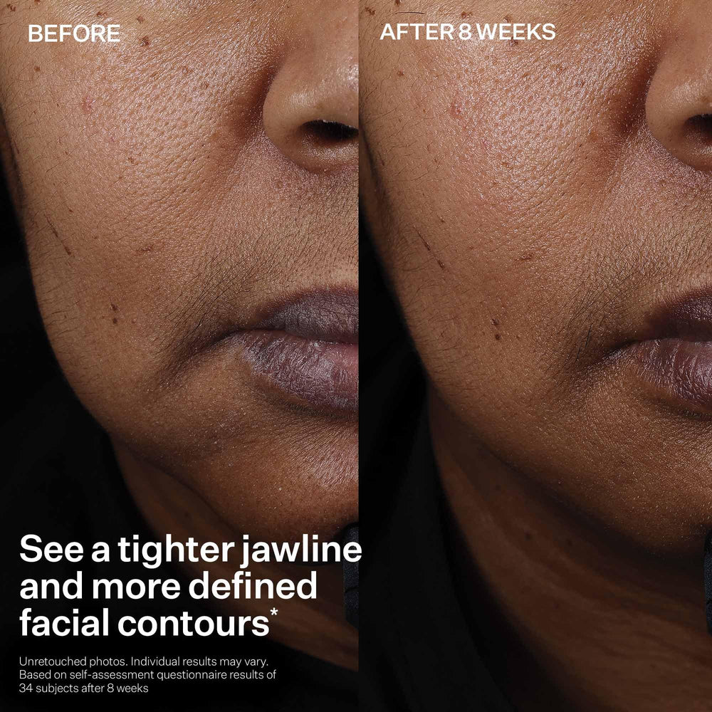 StriVectin smoothing jawline and cheek to show improved contour and tone