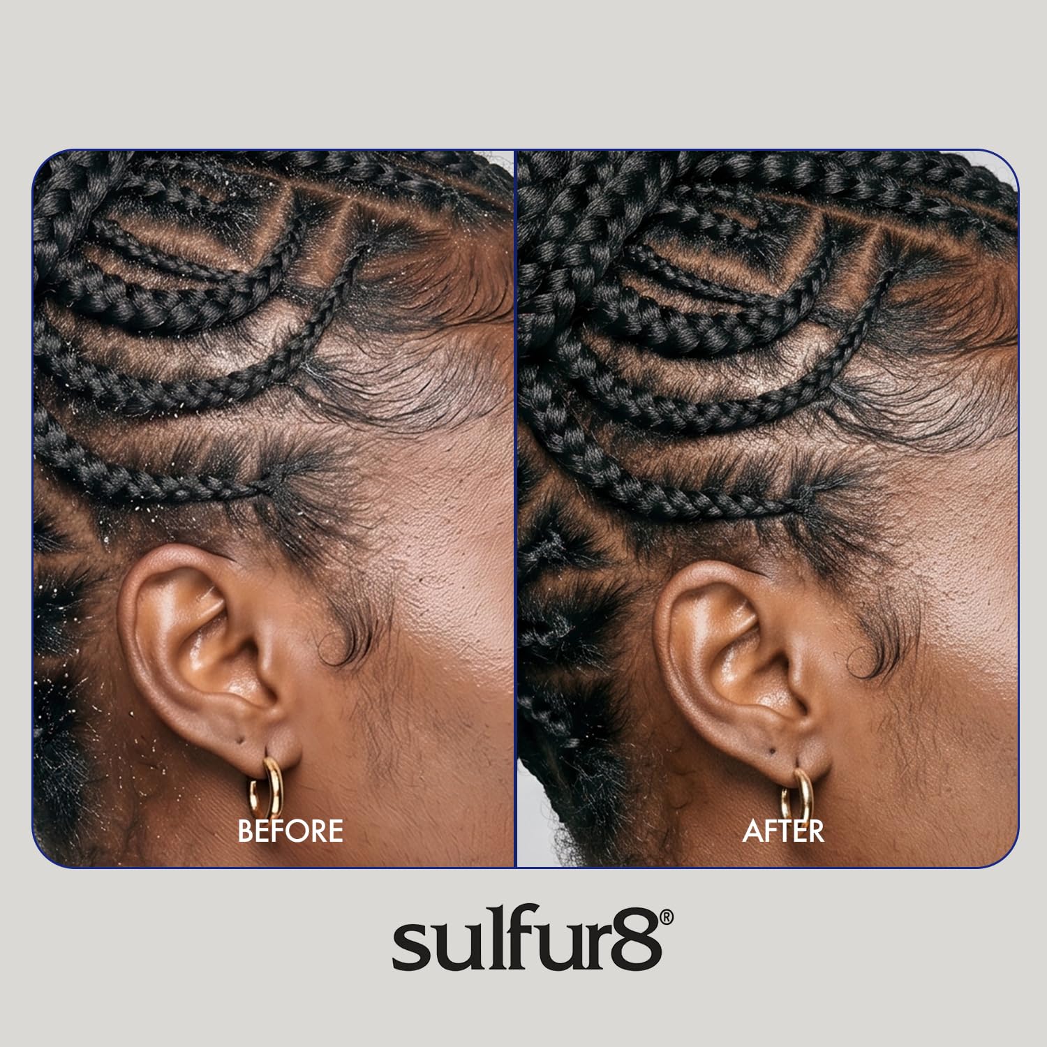 SULFUR8 applied to scalp demonstrating soothing and moisturizing