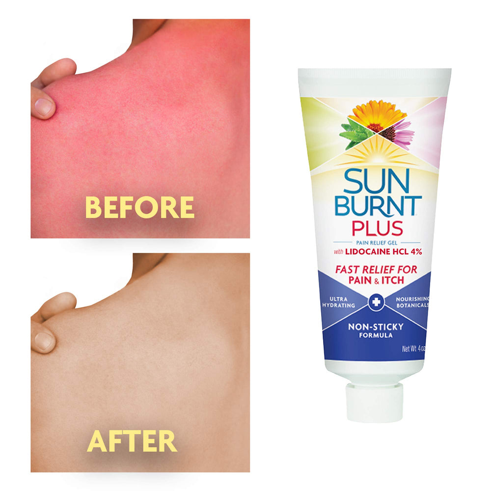 Sunburnt brand gel being smoothed on forearm to reduce pain and itch