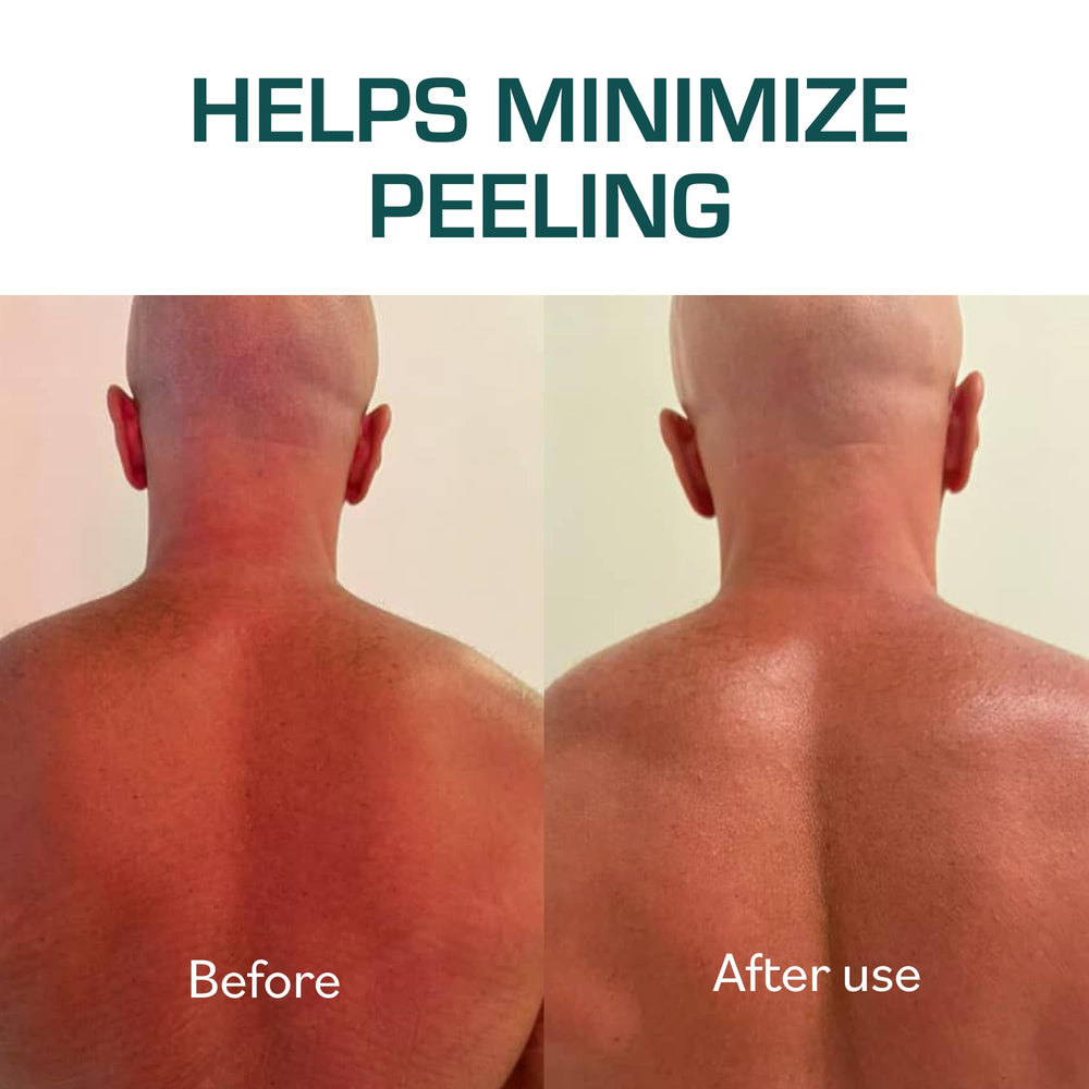 TERNS Mayday used on a beach after sun exposure demonstrating immediate cooling