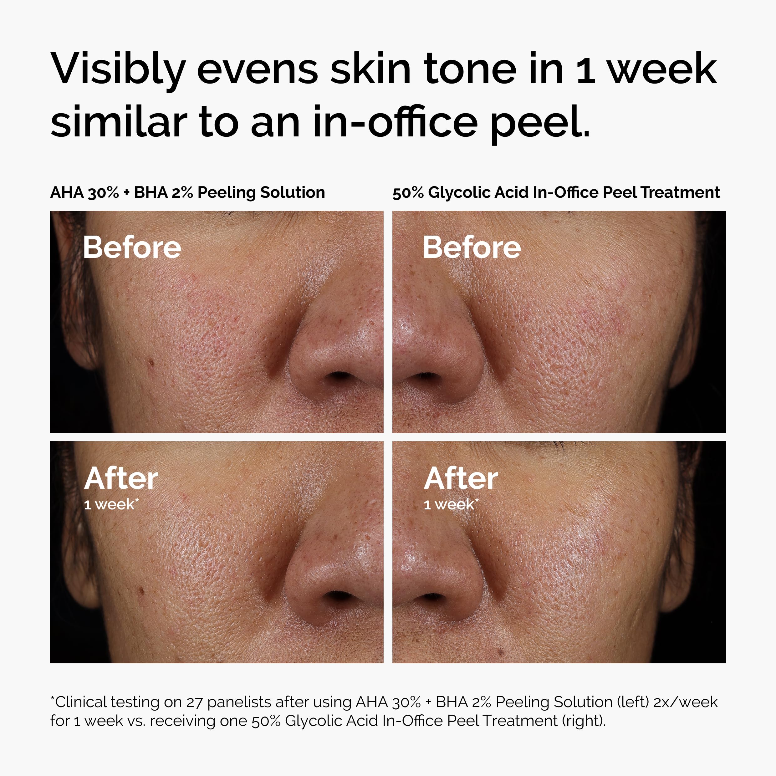 The Ordinary peeling solution ingredients label closeup, clarifies key actives and supportive hydration
