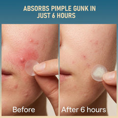 TKGOU invisible patch on cheek under light makeup for discreet blemish concealment
