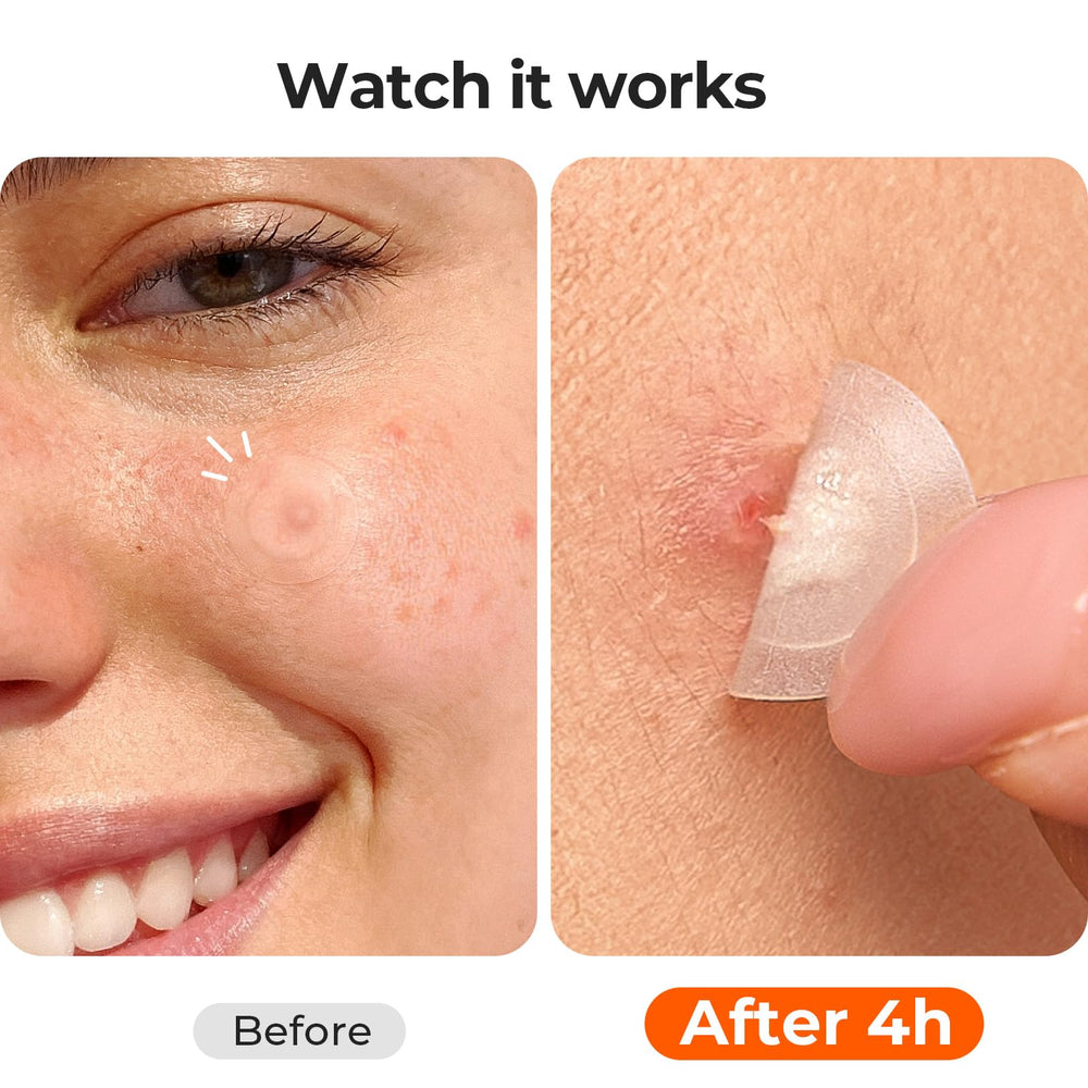 TKTK hydrocolloid center texture absorbing fluids for flatter blemishes