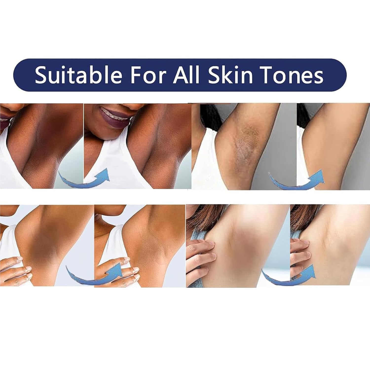 Vcetree used on bikini area highlighting targeted dark spot care