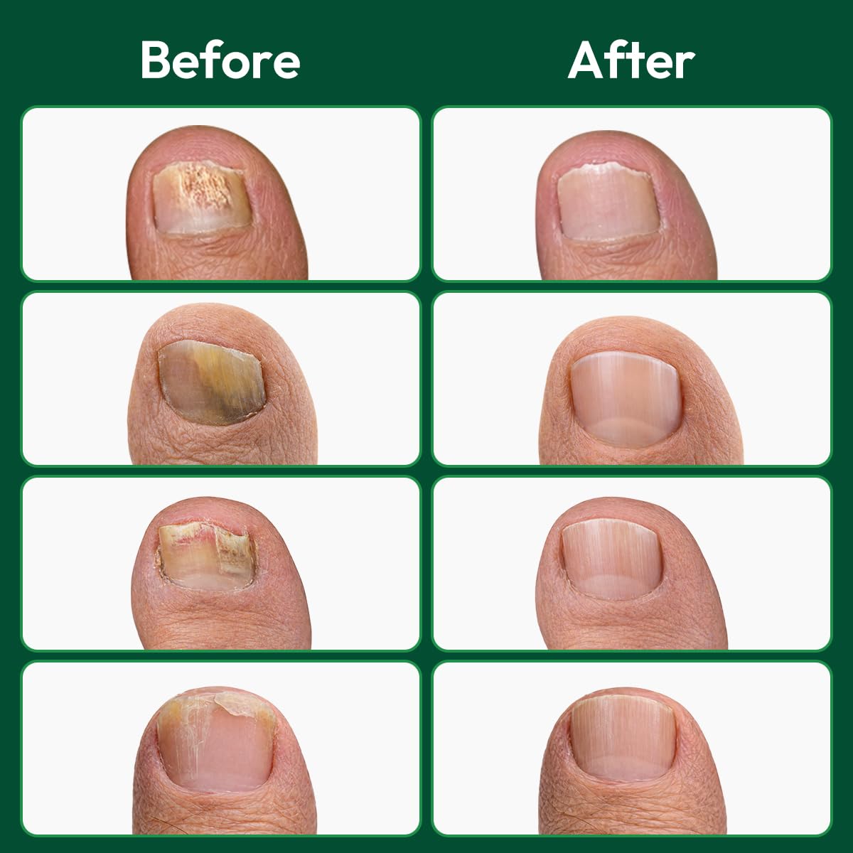 VERDORA patch applied to toenail demonstrating secure fit