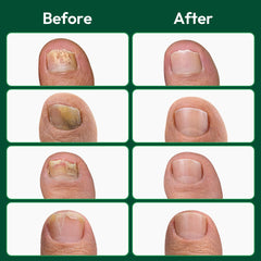 VERDORA patch applied to toenail demonstrating secure fit