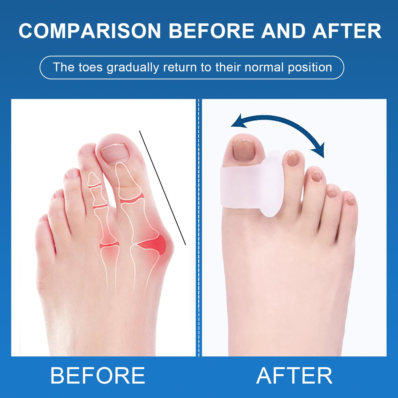 Viexpand gel spacer inside athletic shoe reducing friction during activity