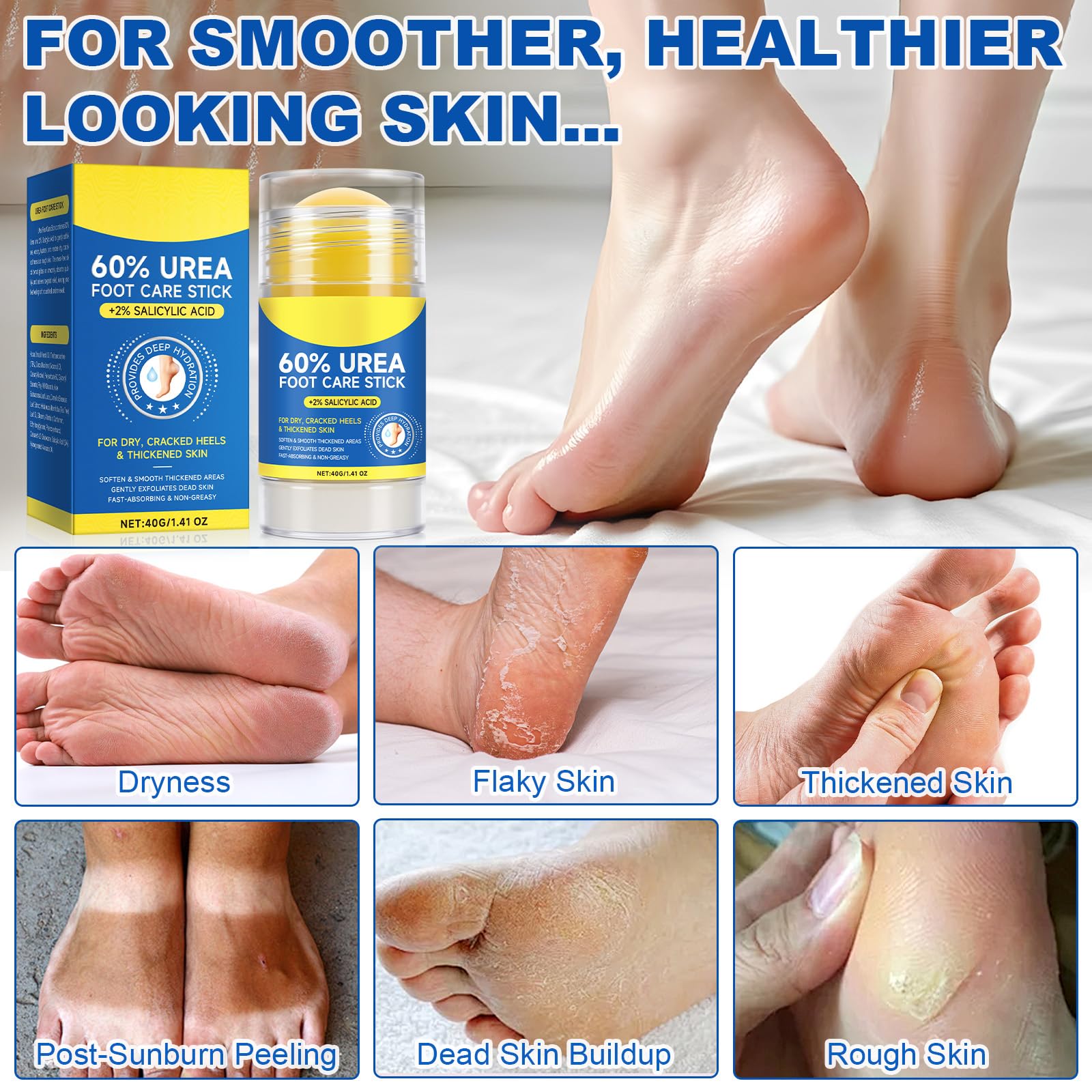 YUEPLATTNMAY application on heel demonstrating softening effect