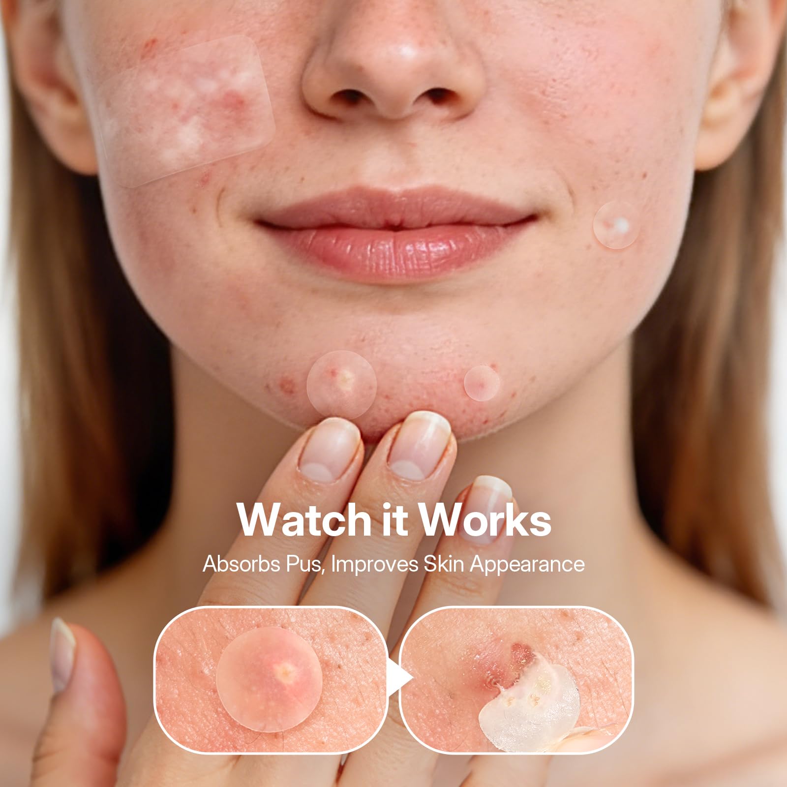 ZATKTK hydrocolloid close-up showing absorbent texture for spots