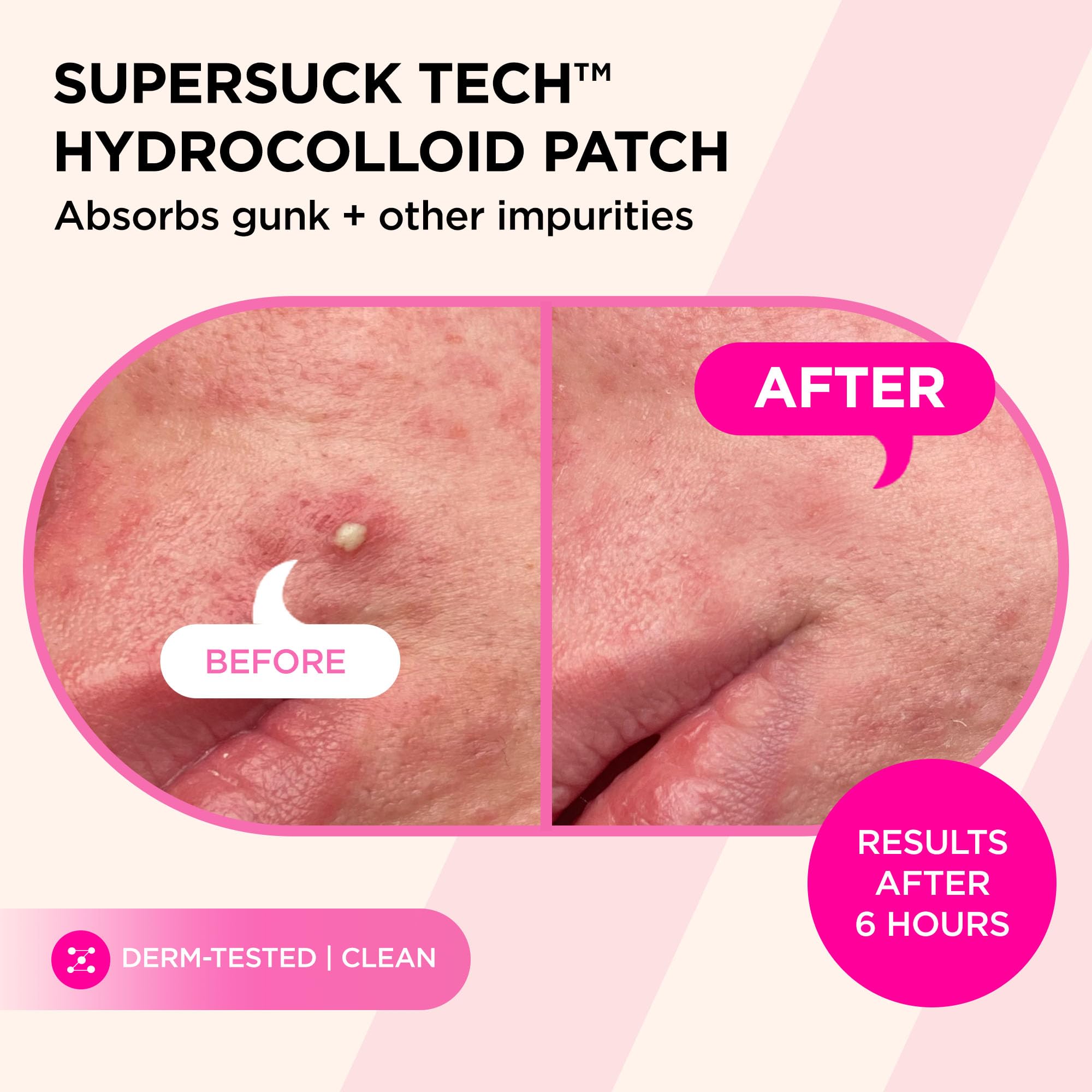 ZitSticka patch applied on cheek overnight showing discreet treatment benefit