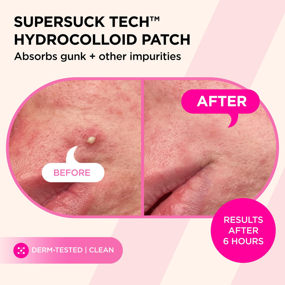 ZitSticka patch applied on cheek overnight showing discreet treatment benefit