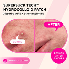 ZitSticka patch applied on cheek overnight showing discreet treatment benefit