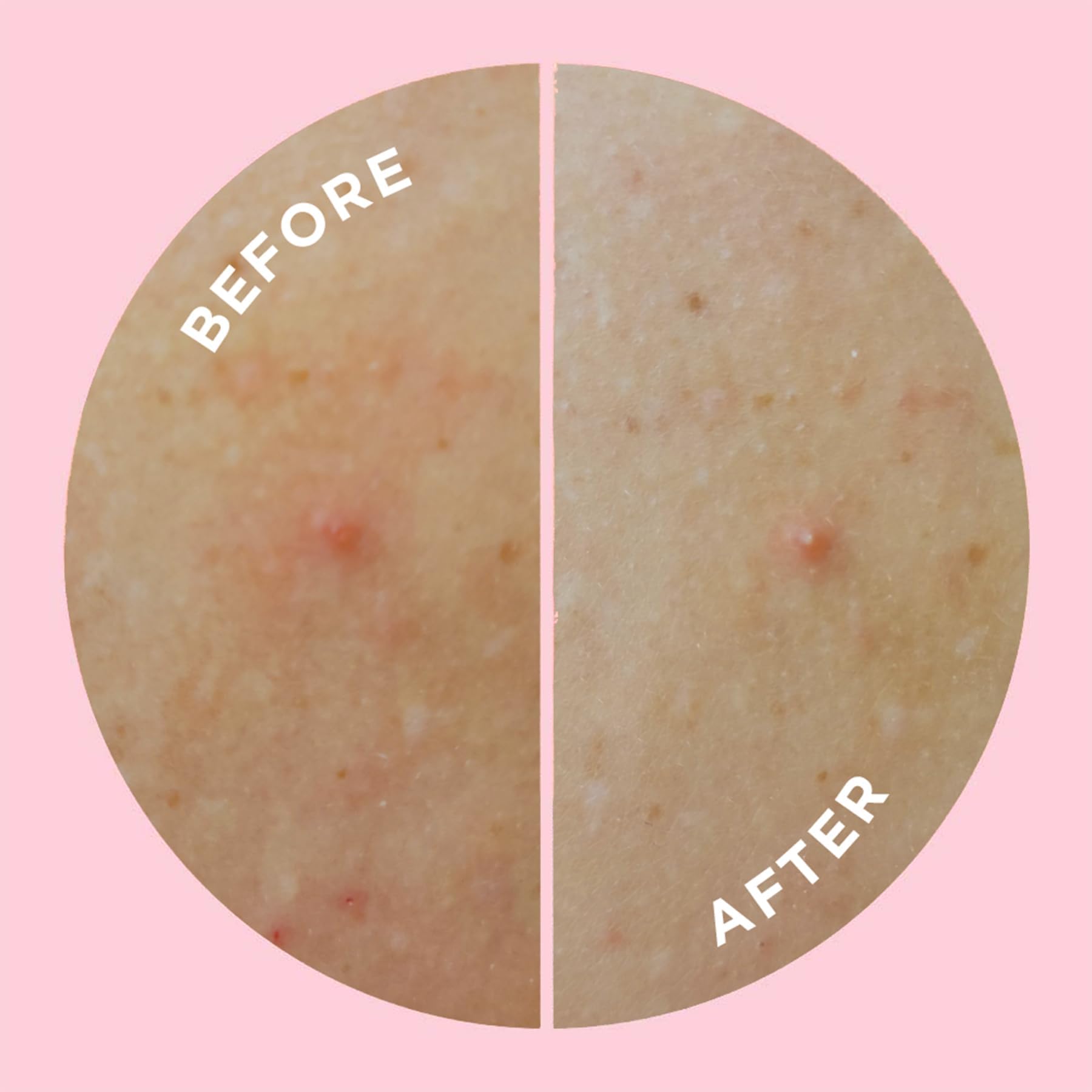 ZitSticka ingredients label highlighting salicylic acid and niacinamide